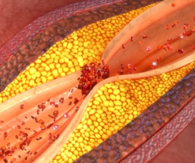 Bệnh tắc nghẽn động mạch