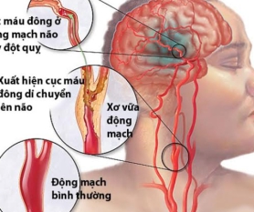 Bệnh Tai Biến Mạch Máu Não